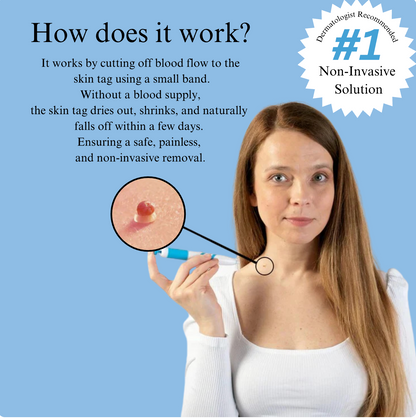 Skin Tag Remover