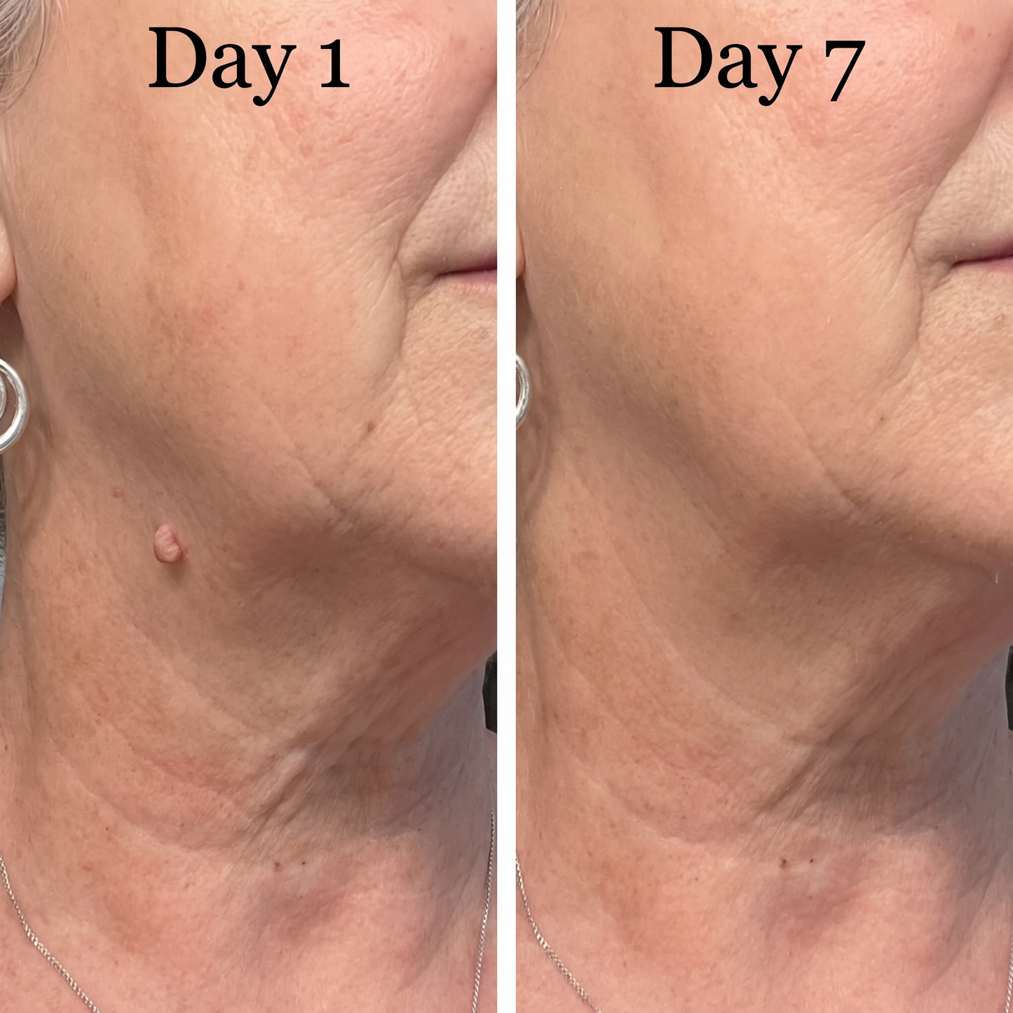 Skin Tag Remover